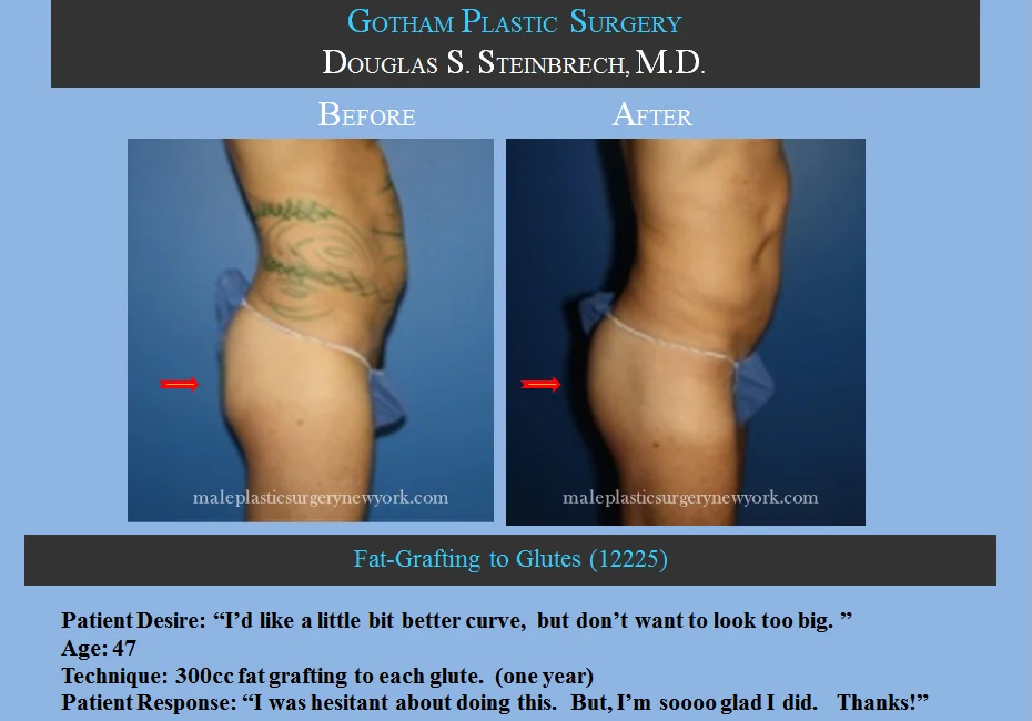 Fat Grafting - Before & After Photos