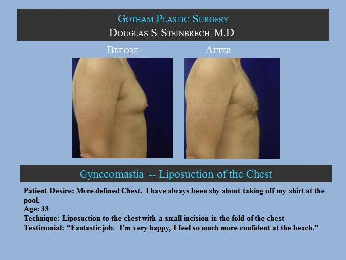 Gynecomastia - Before & After Photos