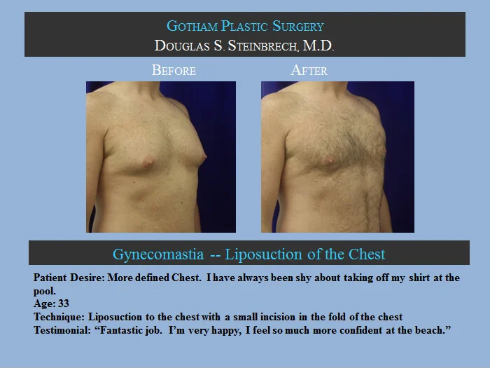 Gynecomastia - Before & After Photos