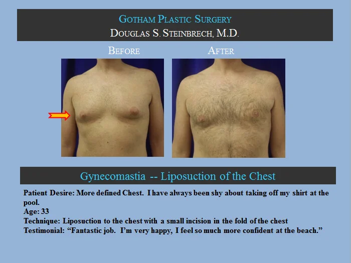 Gynecomastia - Before & After Photos