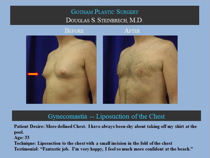 Gynecomastia - Before & After Photos