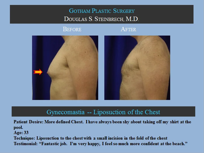 Gynecomastia - Before & After Photos