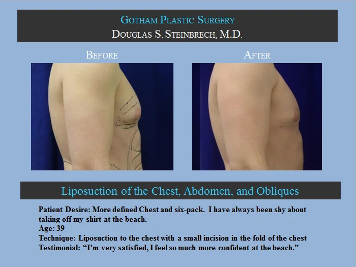 Gynecomastia - Before & After Photos