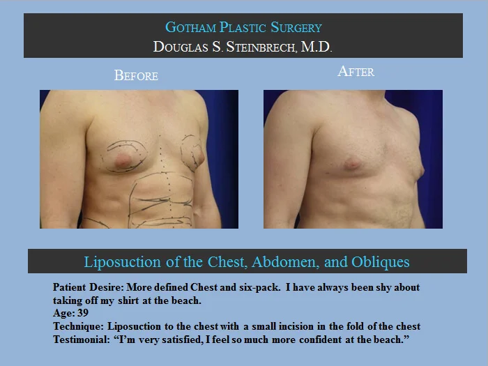 Gynecomastia - Before & After Photos