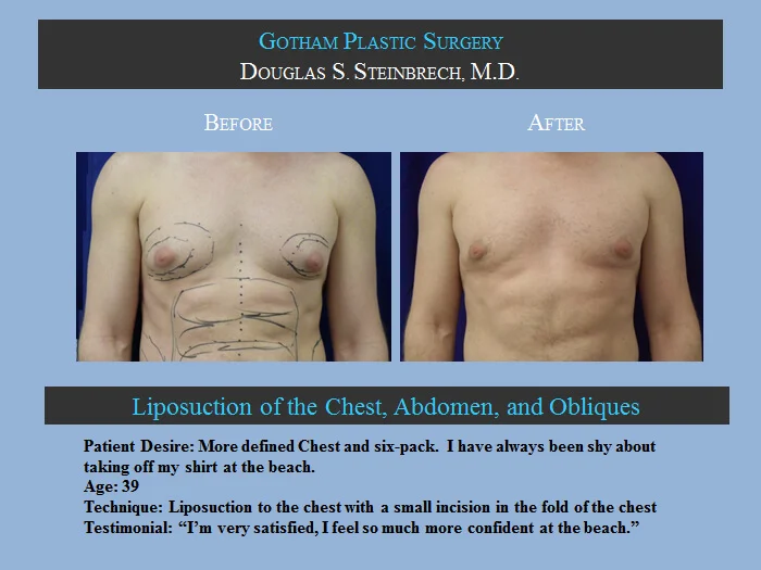 Gynecomastia - Before & After Photos