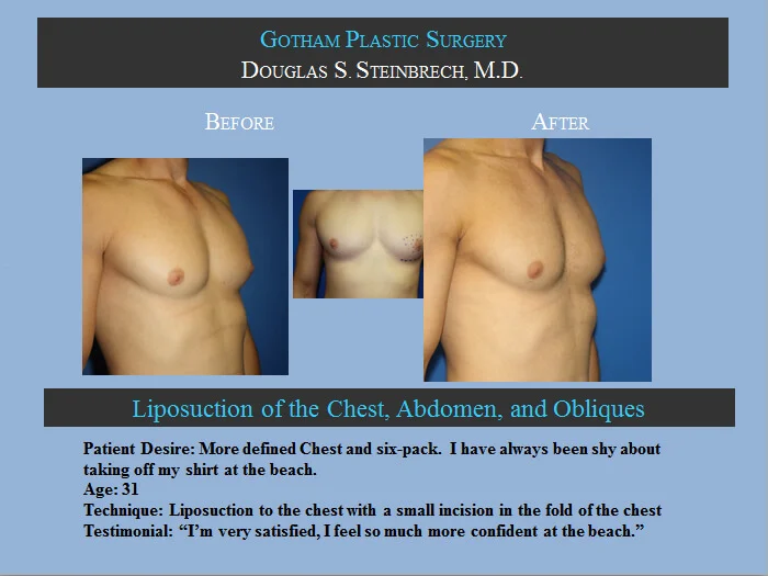 Gynecomastia - Before & After Photos