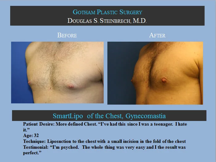 Gynecomastia - Before & After Photos