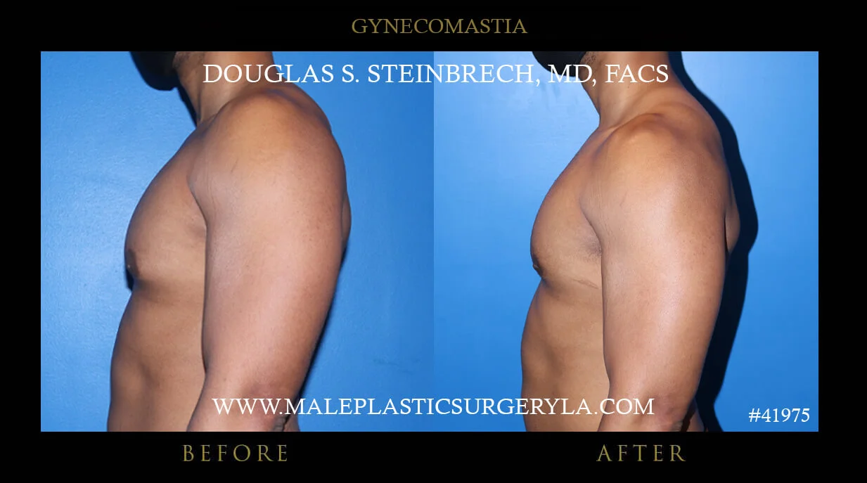 Gynecomastia - Before & After Photos