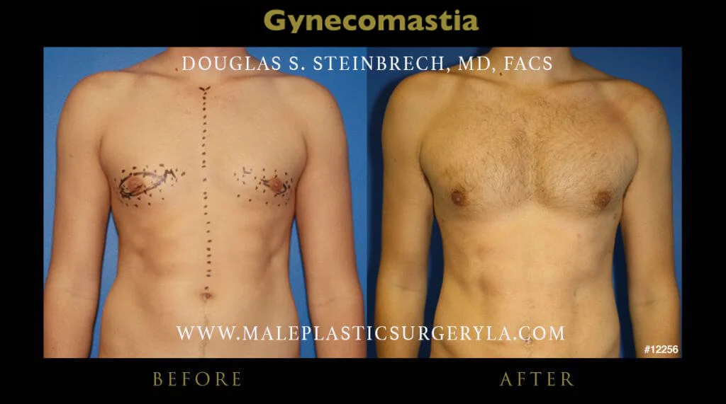 Gynecomastia - Before & After Photos