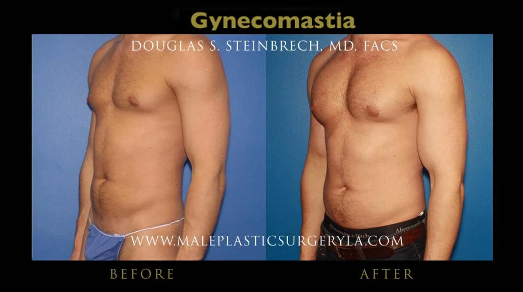 Gynecomastia - Before & After Photos