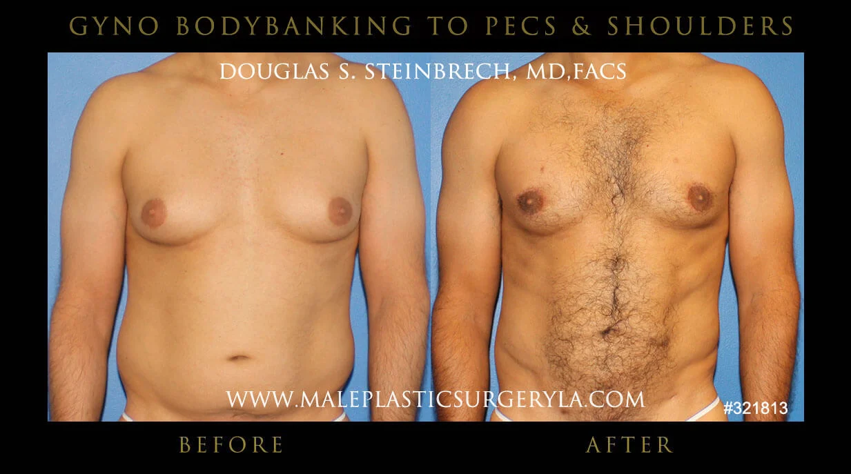 Gynecomastia - Before & After Photos