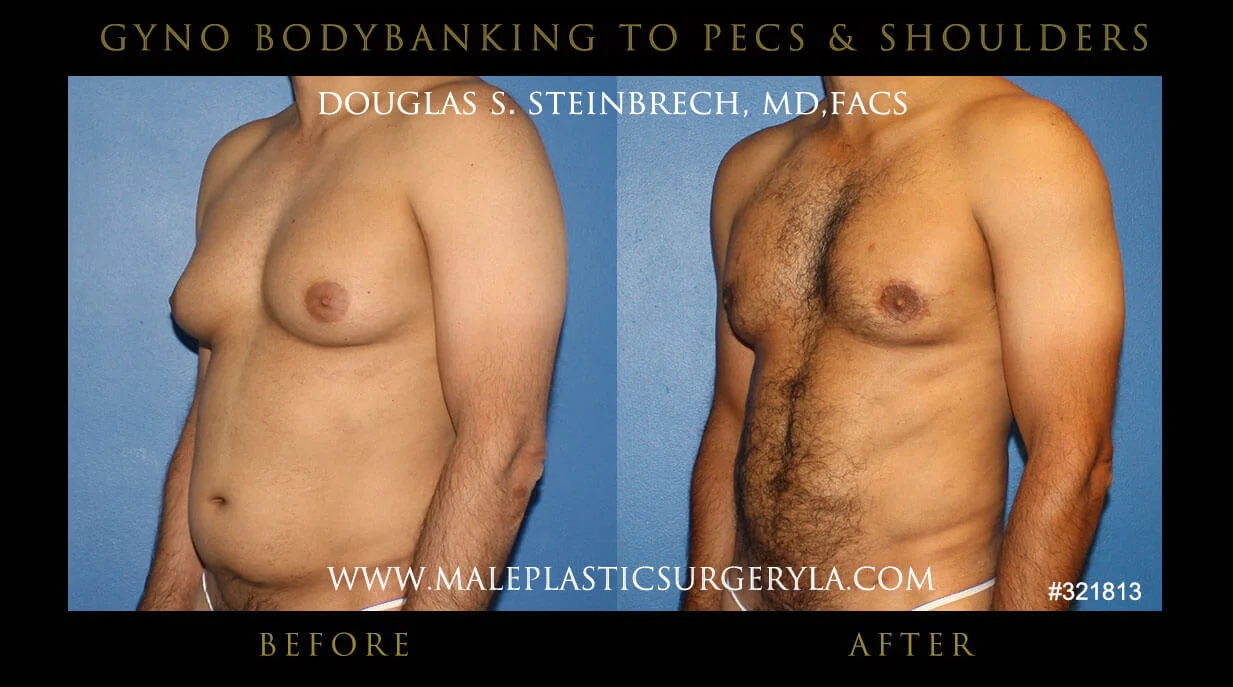 Gynecomastia - Before & After Photos