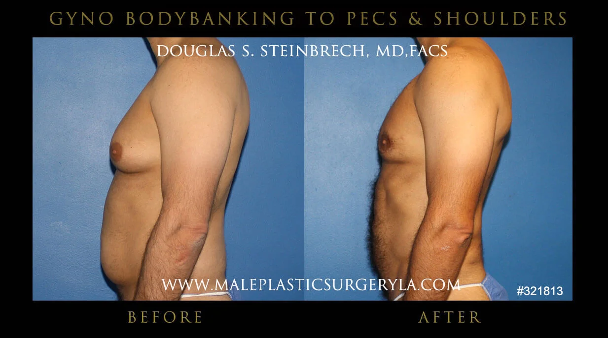 Gynecomastia - Before & After Photos