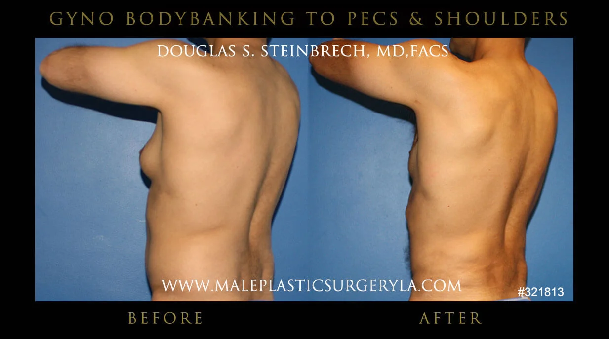 Gynecomastia - Before & After Photos