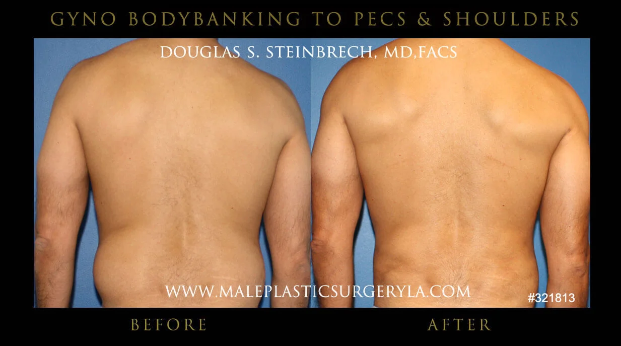 Gynecomastia - Before & After Photos