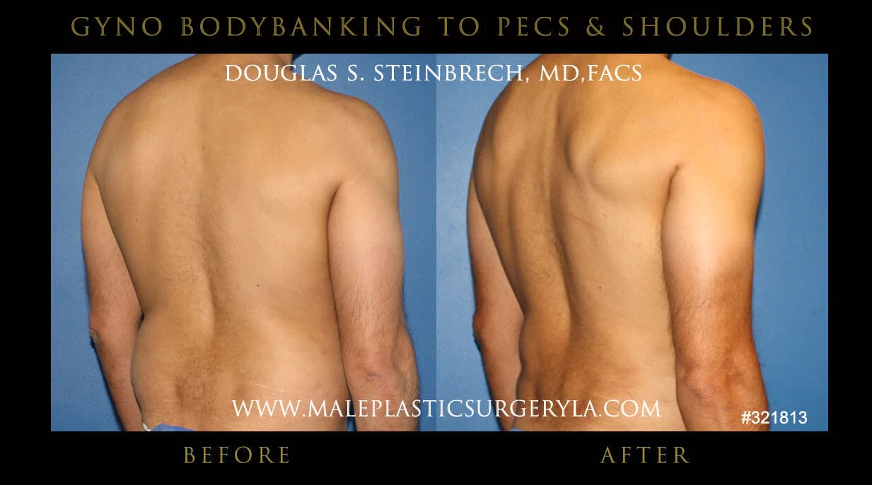 Gynecomastia - Before & After Photos