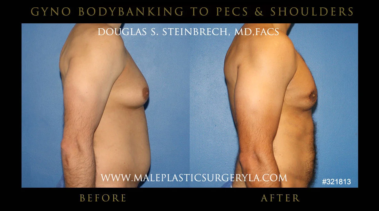 Gynecomastia - Before & After Photos