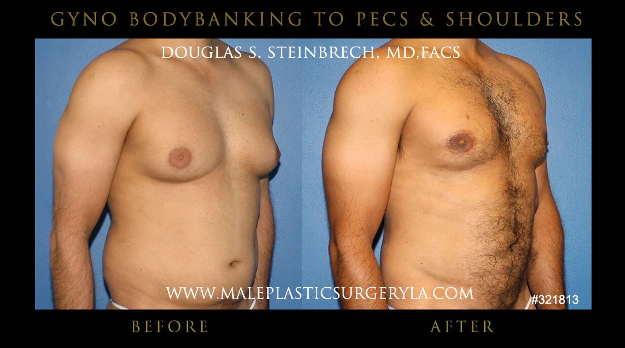 Gynecomastia - Before & After Photos