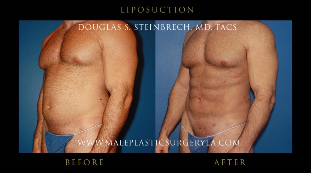 Liposuction - Before & After Photos