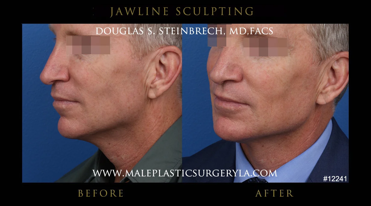 Jawline Sculpting - Before & After Photos