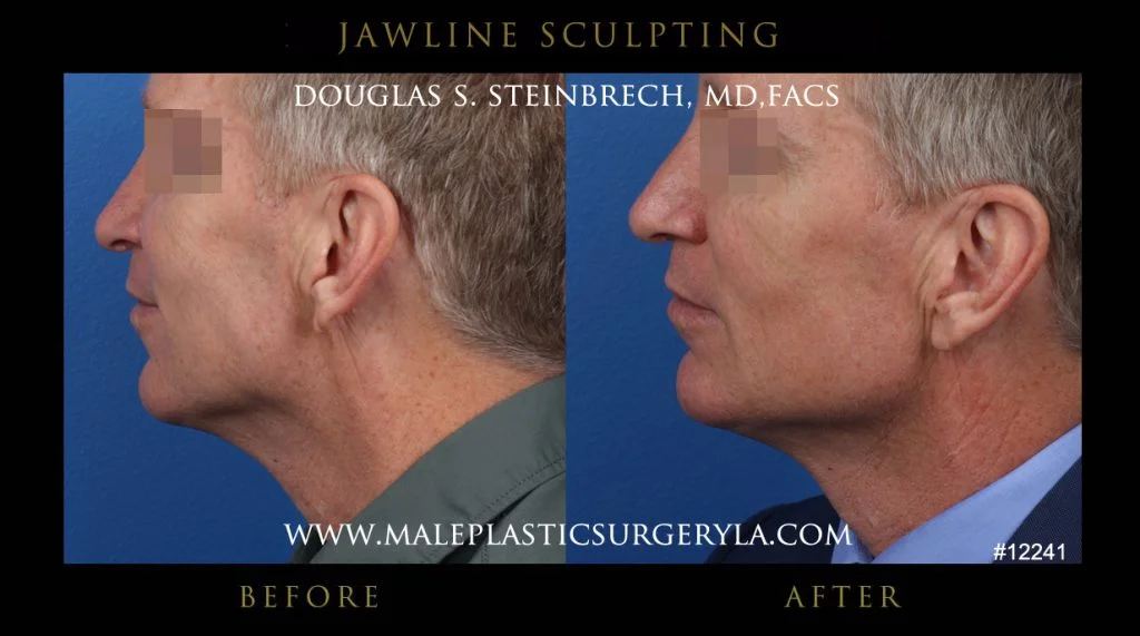 Jawline Sculpting - Before & After Photos