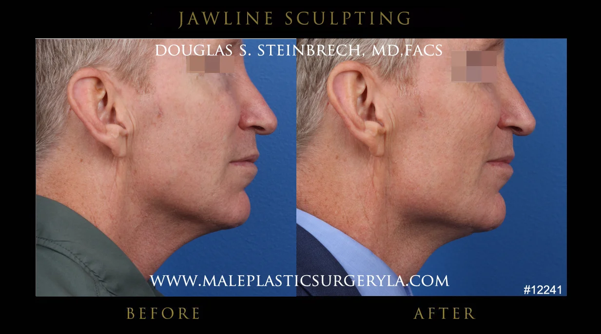 Jawline Sculpting - Before & After Photos