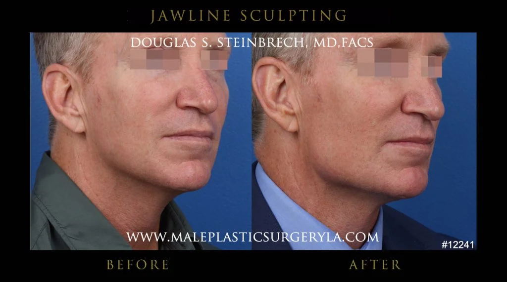 Jawline Sculpting - Before & After Photos