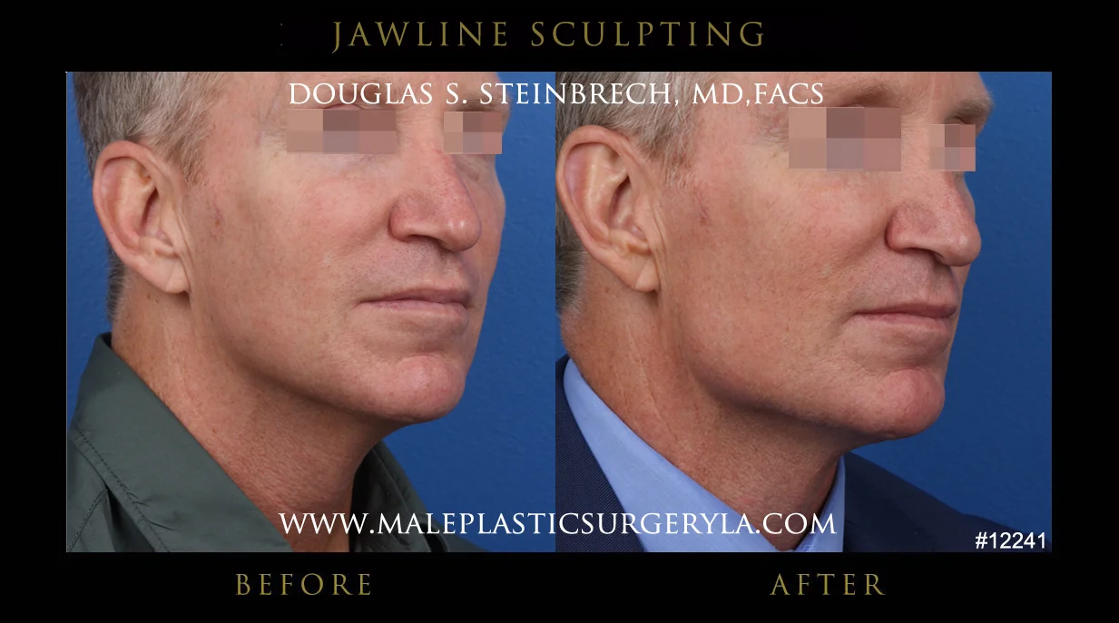 Jawline Sculpting - Before & After Photos