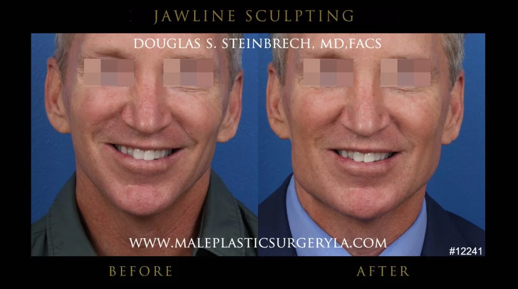 Jawline Sculpting - Before & After Photos