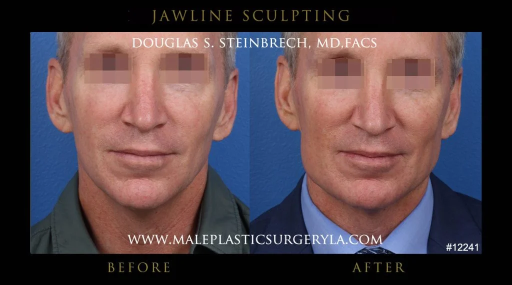 Jawline Sculpting - Before & After Photos