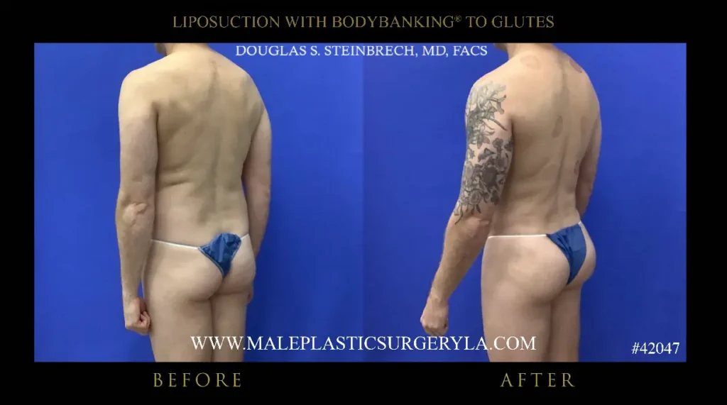 lipo-bodybanking-glutes-135-degree-la