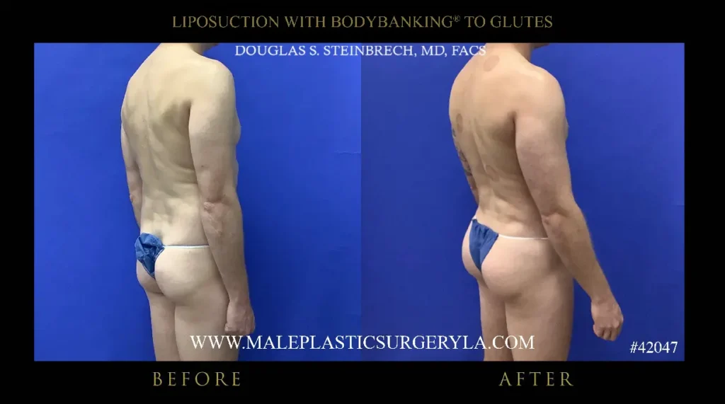 lipo-bodybanking-glutes-225-degree-la