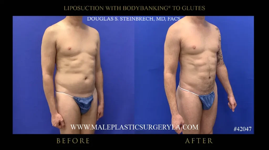 lipo-bodybanking-glutes-315-degree-la