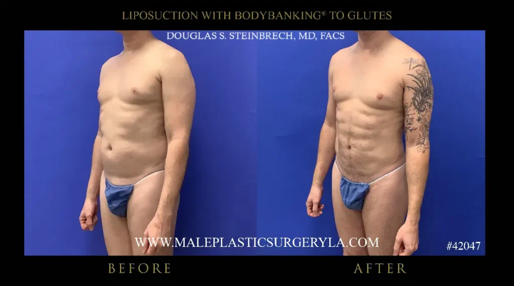 lipo-bodybanking-glutes-45-degree-la