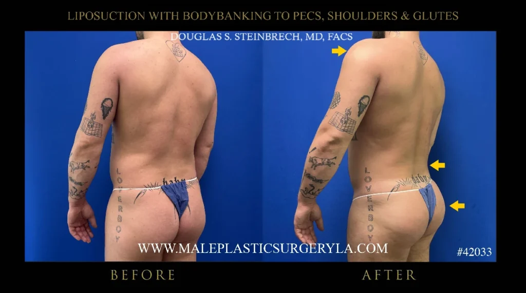 lipo-bodybanking-glutes-45degree-view-la