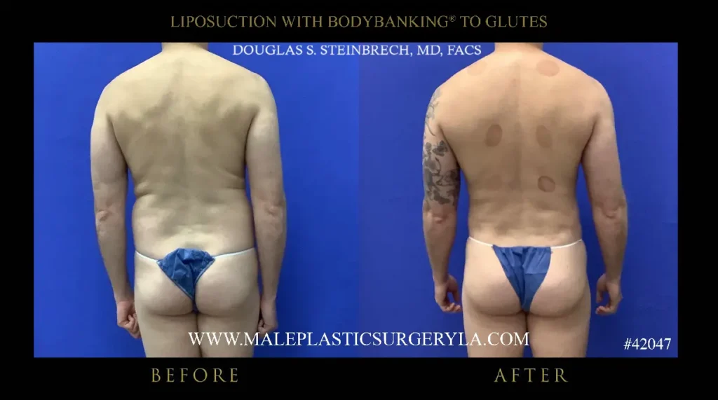 lipo-bodybanking-glutes-back-view-la