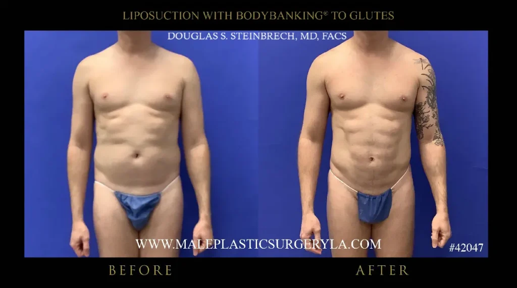 lipo-bodybanking-glutes-front-view-la
