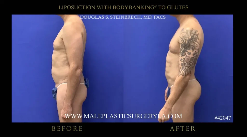 lipo-bodybanking-glutes-left-side-profile-la