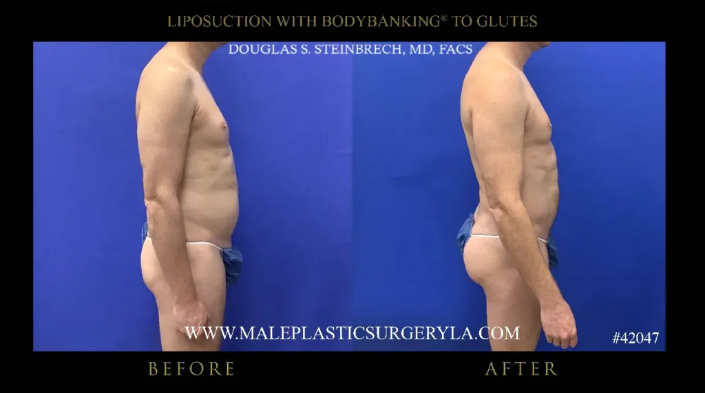 lipo-bodybanking-glutes-right-side-profile-la