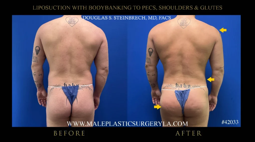 lipo-bodybanking-glutes-straight-on-la