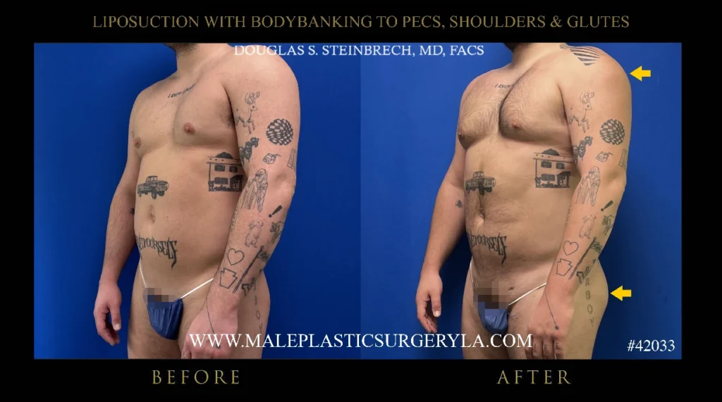 lipo-bodybanking-pecs-shoulders-glutes-45degree-left-la