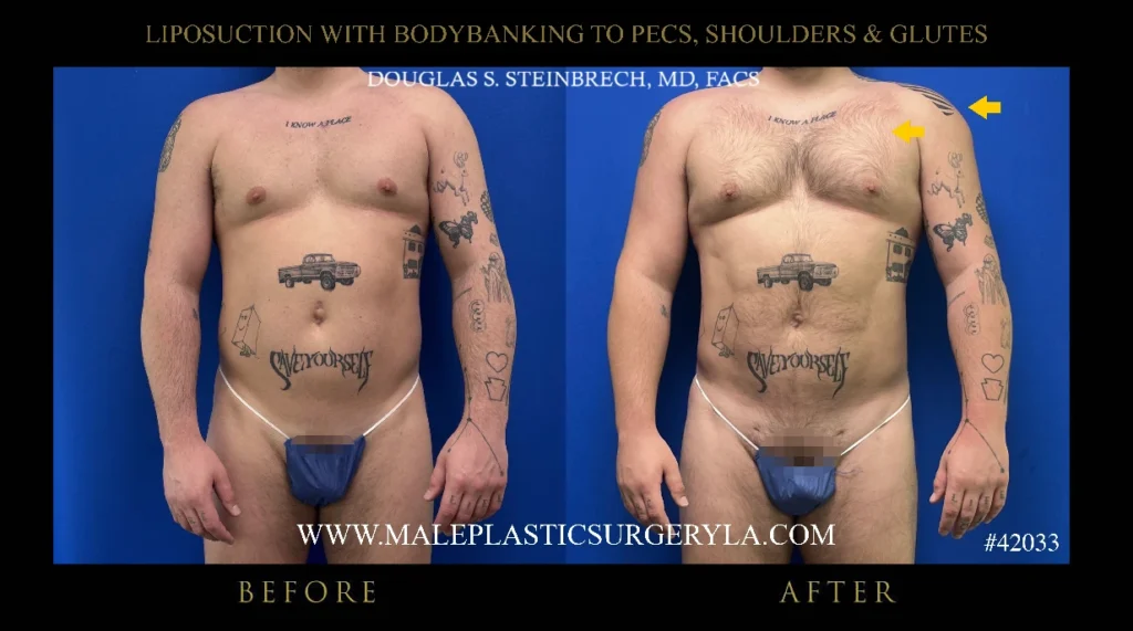 lipo-bodybanking-pecs-shoulders-glutes-before-after-la