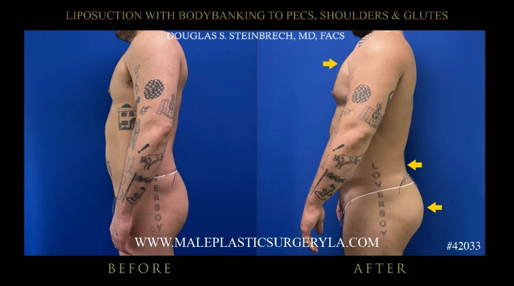 lipo-bodybanking-pecs-shoulders-glutes-side-profile-la
