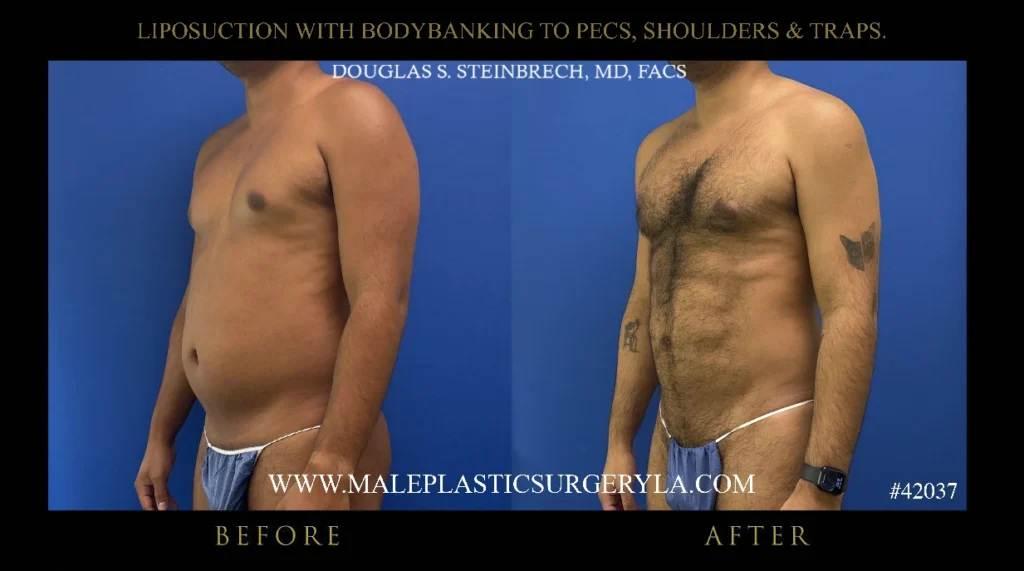 lipo-bodybanking-pecs-shoulders-traps-45degree-left-la