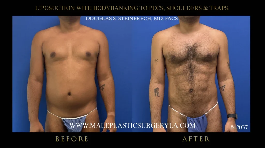 lipo-bodybanking-pecs-shoulders-traps-before-after-la