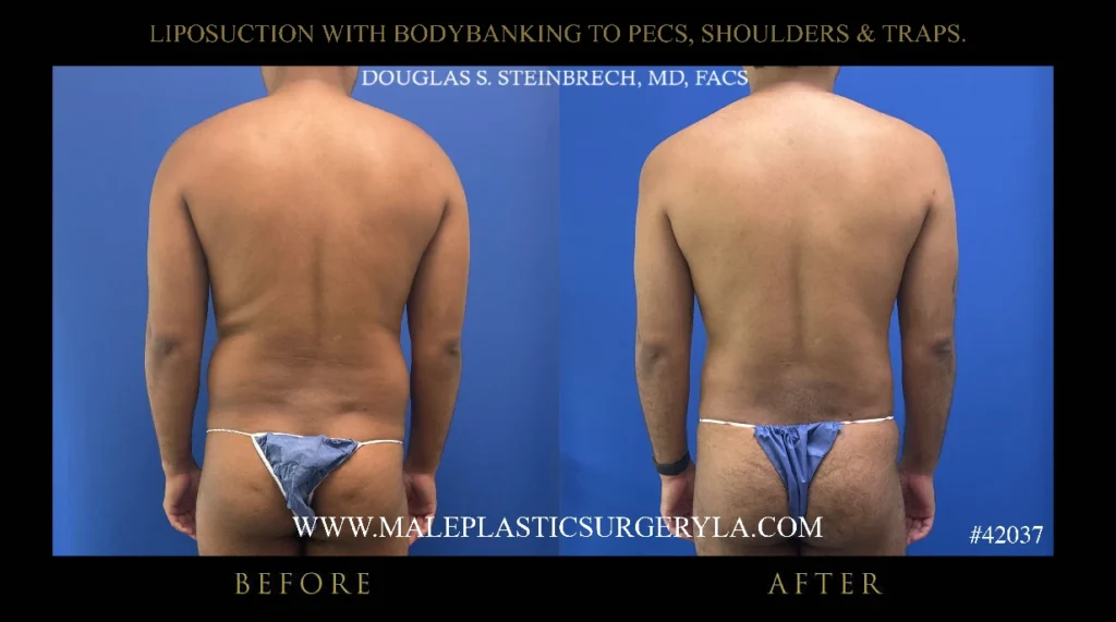 lipo-bodybanking-pecs-shoulders-traps-glutes-straight-on-la