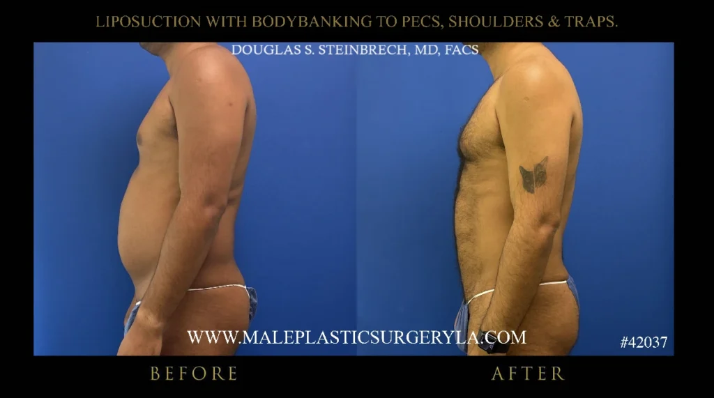 lipo-bodybanking-pecs-shoulders-traps-side-profile-la