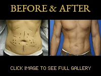 Liposuction - Before & After Photos