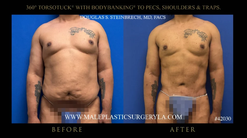Los Angeles patient: front-view results of abdominal and torso definition achieved through TorsoTuck and BodyBanking procedures.