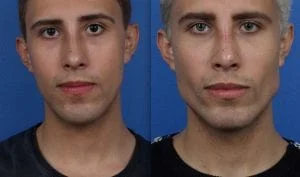 Jaw Augmentation - Before & After Photo